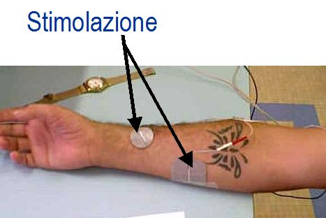 Location of stimulation electrodes